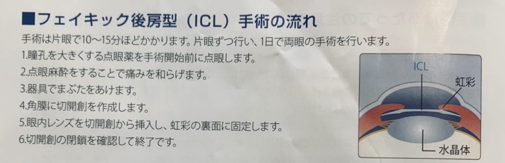 視力0 06 1 5 Icl手術体験談まとめ 事前検査から術後期間まで解説 いつまでもアフタースクール